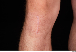 Trent knee nude scar 0001.jpg